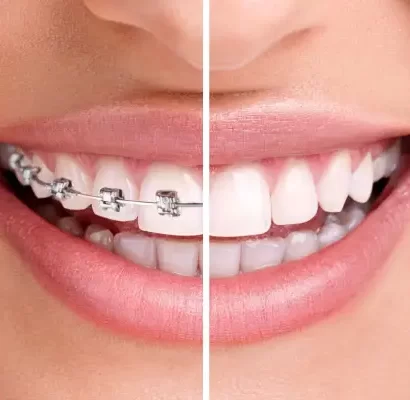 dental-braces