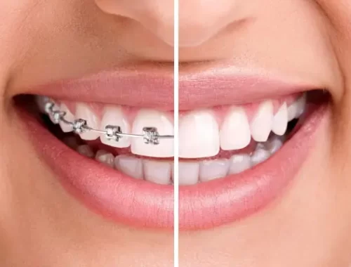 dental-braces