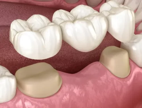 dental-bridges