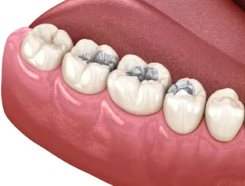 tooth-coloured-fillings