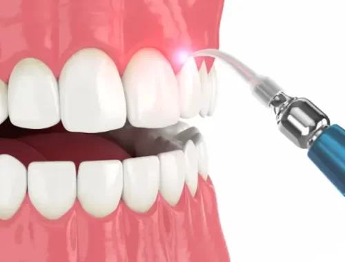 laser-dentistry