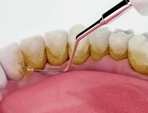 scalling-and-polishing