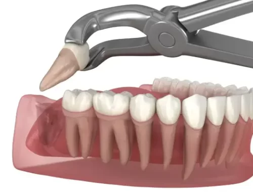 wisdom-teeth-removal